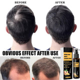 Sada Advanced Hair Growth Treatment Kit 30 ml 2ks Sprej pro růst vlasů Váleček a esence sada pro růst vlasů Sérum na růst vlasů proti vypadávání vlasů Sérum pro pokročilý růst vlasů Péče o vlasy Naty Shop